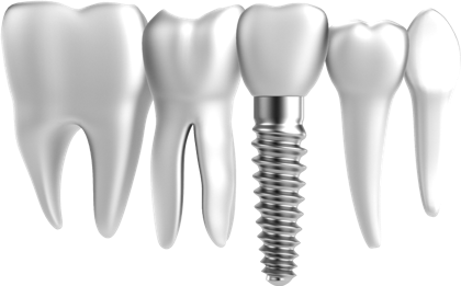 teeth, dental implants costa rica prisma dental #25713