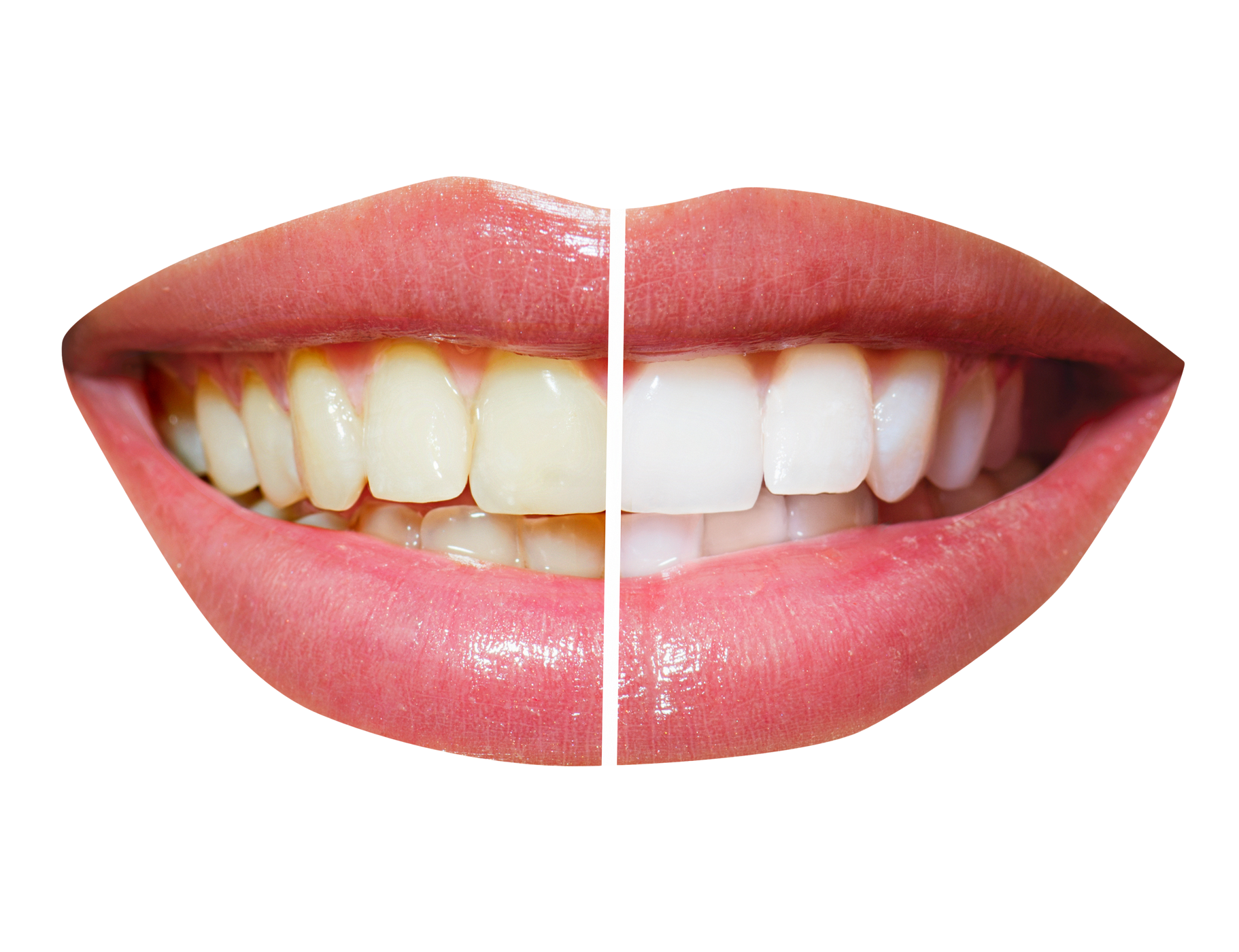 teeth whitening png transparent image pngpix #25665