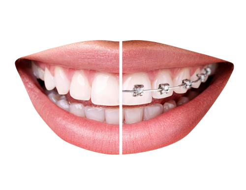 teeth with braces png transparent image pngpix #25671